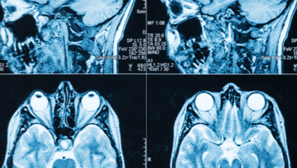 ENFERMAGEM EM NEUROLOGIA